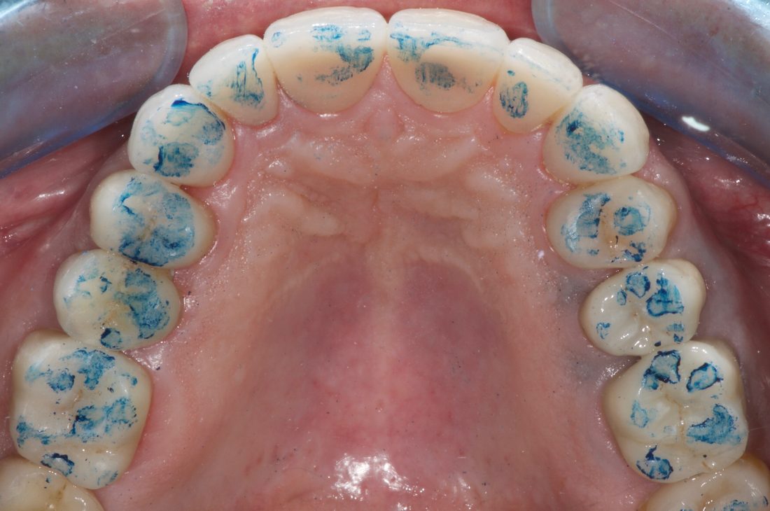 3. Contrôle occlusal : des contacts répartis, quasi sans retouches