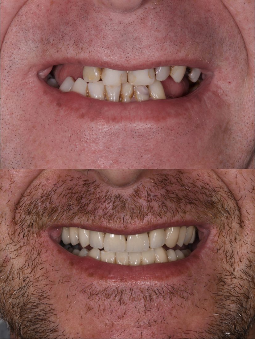 Avant / après : le sourire du patient