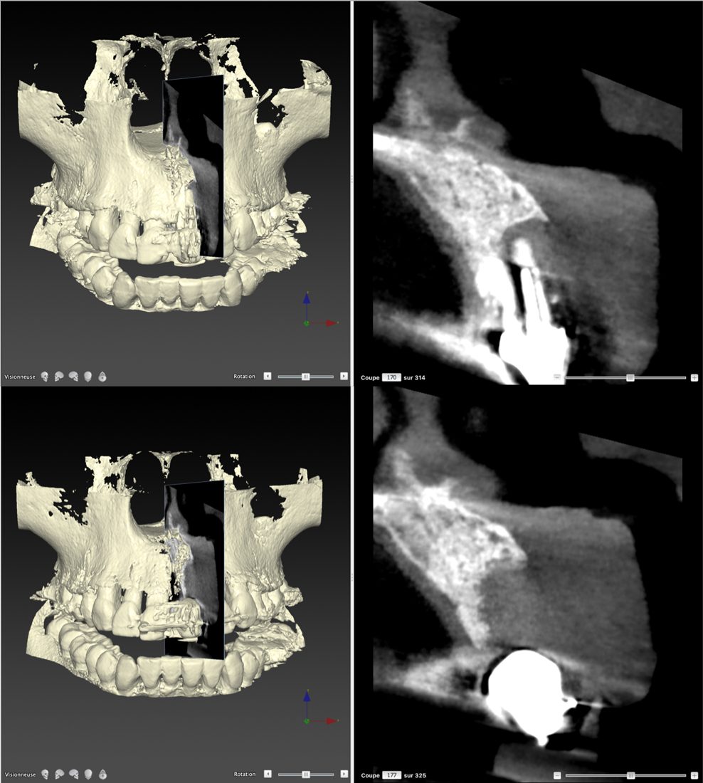 CBCT : le volume osseux à reconstruire, avant / après
