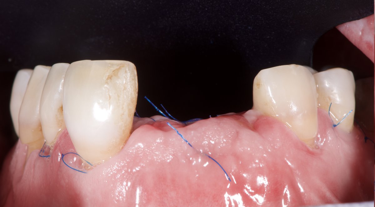 Cicatrisation après la ROG : dépose des sutures