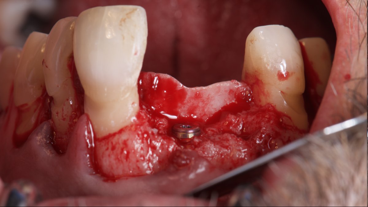 Réentrée à six mois : l'implant posé dans l'os régénéré