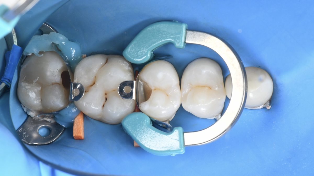 Photo technique — restauration sous digue avec matrices